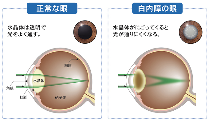 白内障の症状