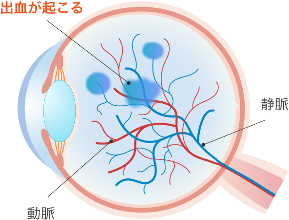 網膜静脈閉塞症・網膜動脈閉塞症